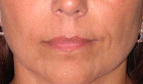 Lip Augmentation - Patient 4 - Before